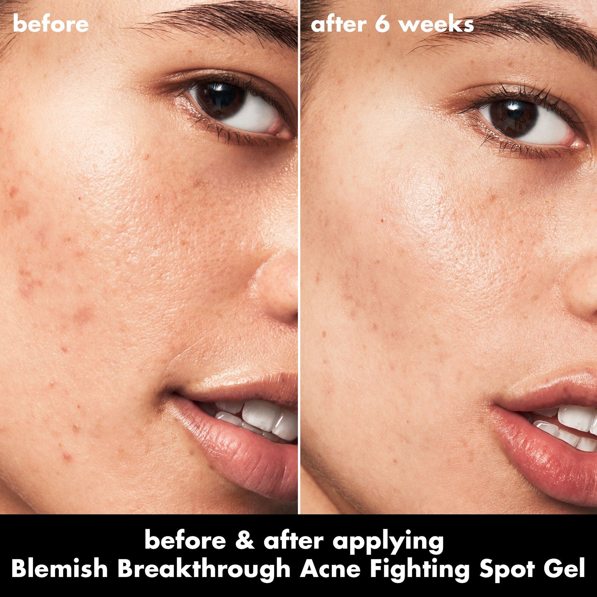 blemish-breakthrough-acne-fighting-spot-gel-i1 0326_EDU_BB_SpotGel_BA_ISABELLA.jpg