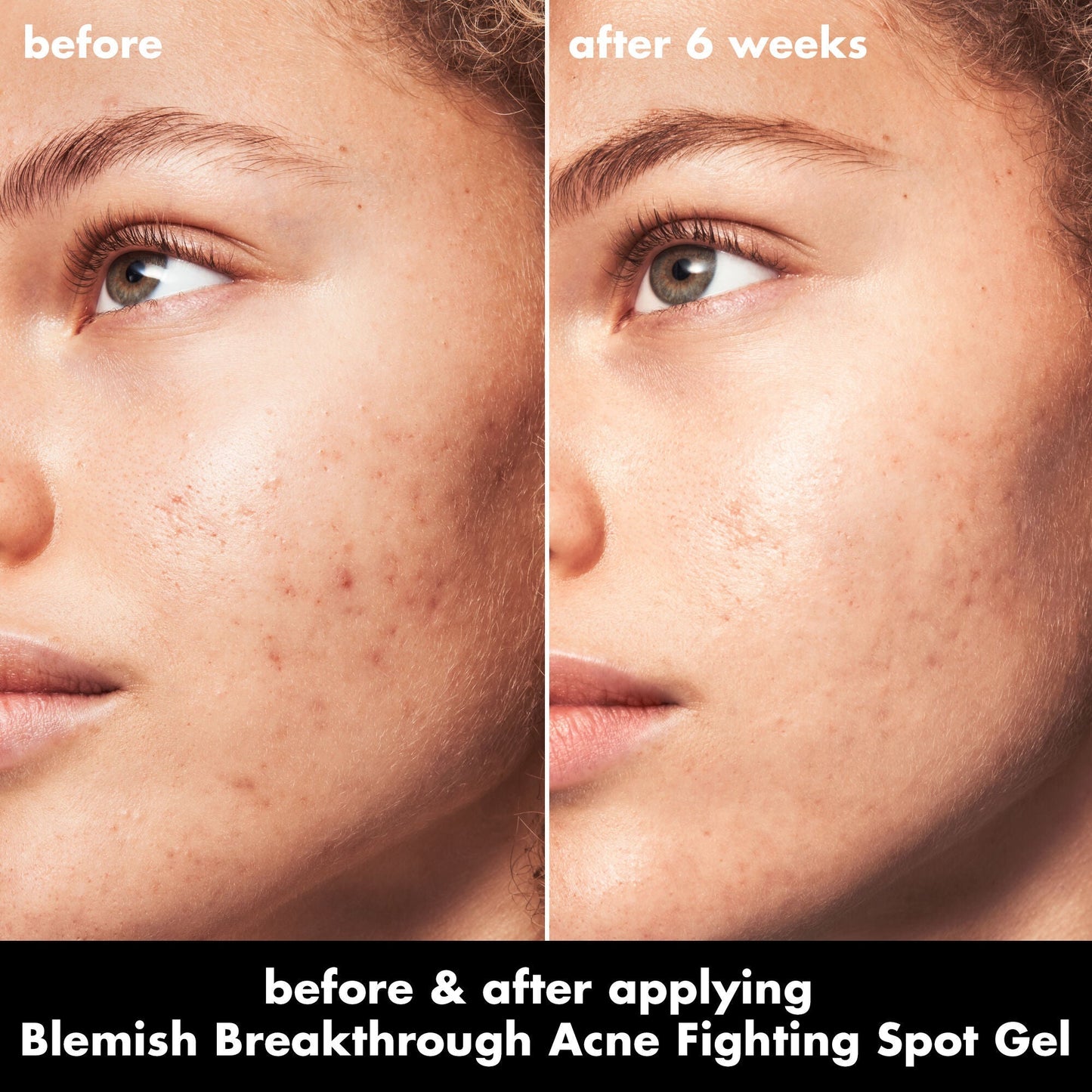 blemish-breakthrough-acne-fighting-spot-gel-i1 0326_EDU_BB_SpotGel_BA_MARLEY.jpg