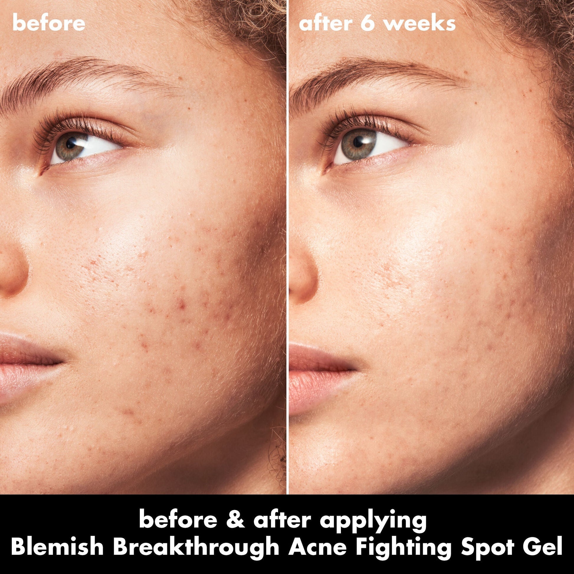 blemish-breakthrough-acne-fighting-spot-gel-i1 0326_EDU_BB_SpotGel_BA_MARLEY.jpg