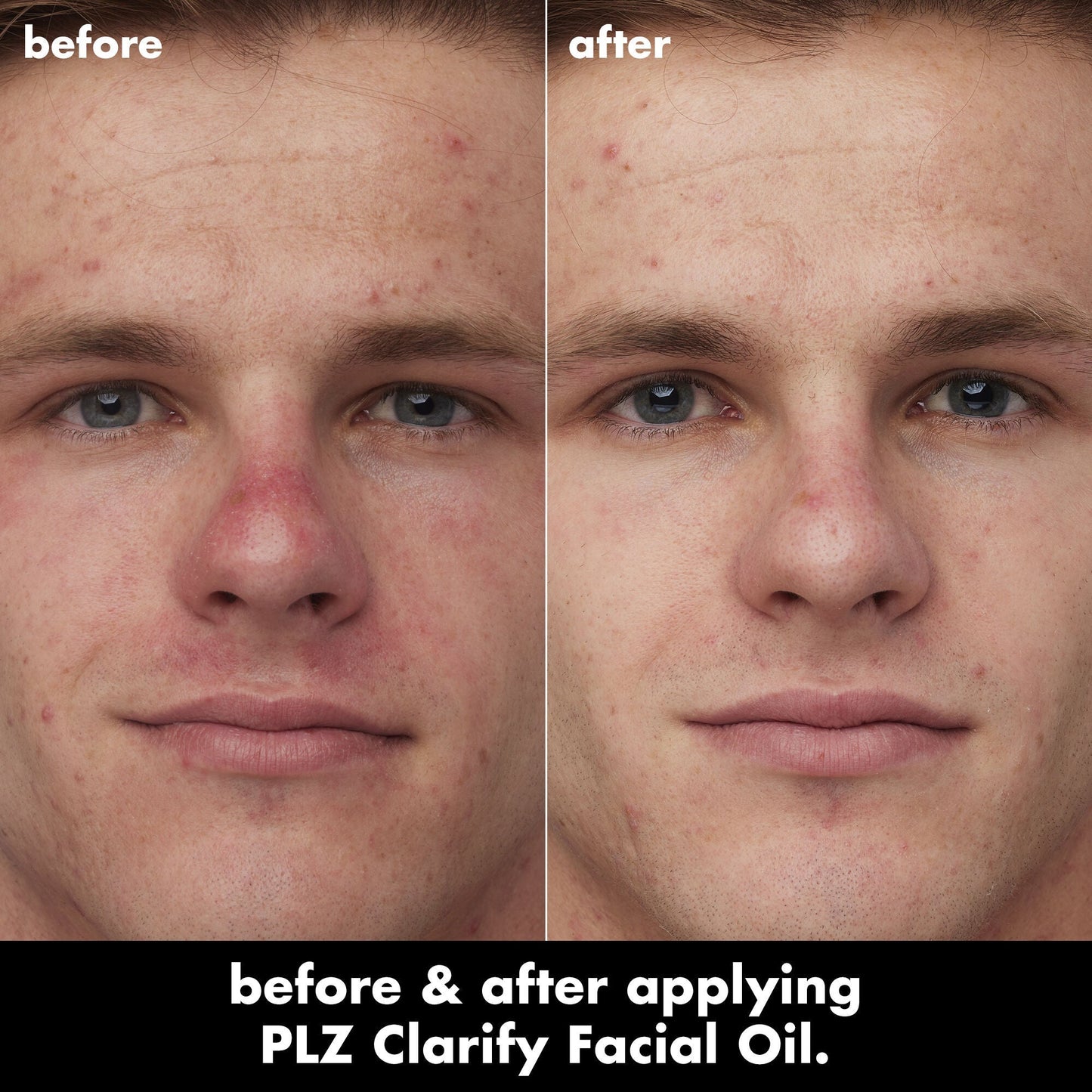 plz-clarify-facial-oil-z8 0326_EDU_PlzClarify_BA_Caleb.jpg