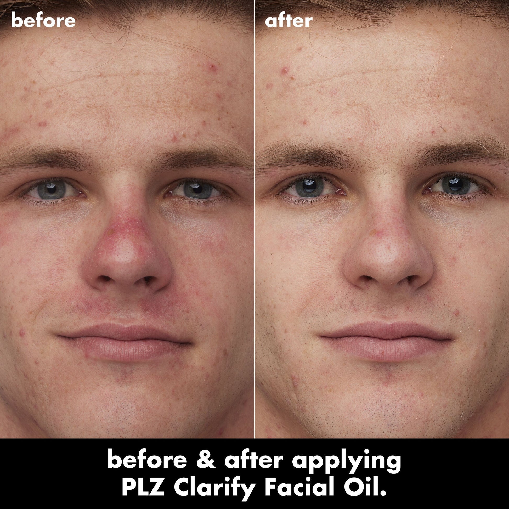 plz-clarify-facial-oil-z8 0326_EDU_PlzClarify_BA_Caleb.jpg