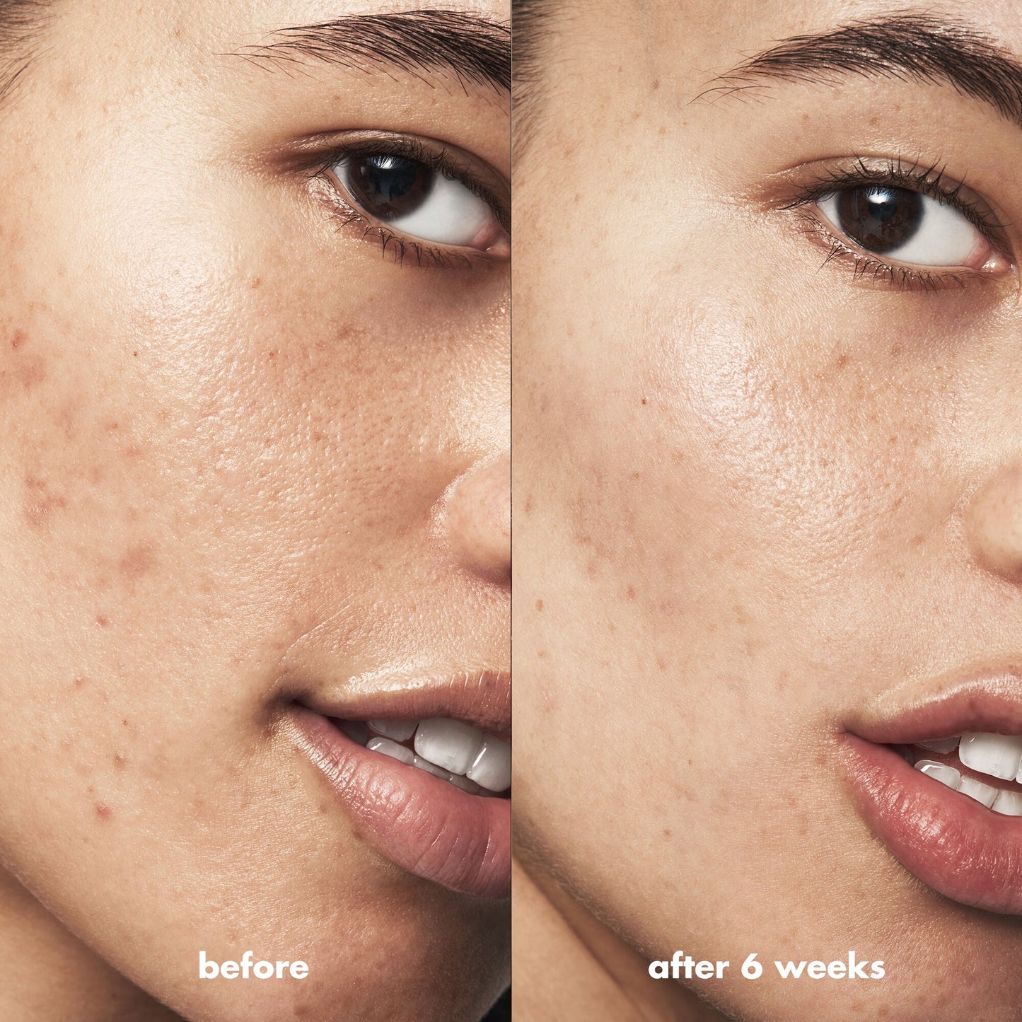 blemish-breakthrough-acne-calming-water-cream-z3 Acne_PDP_Isabella_Before_After_84ce713a-22d2-4bb9-aad7-445c7b27b1c9.jpg