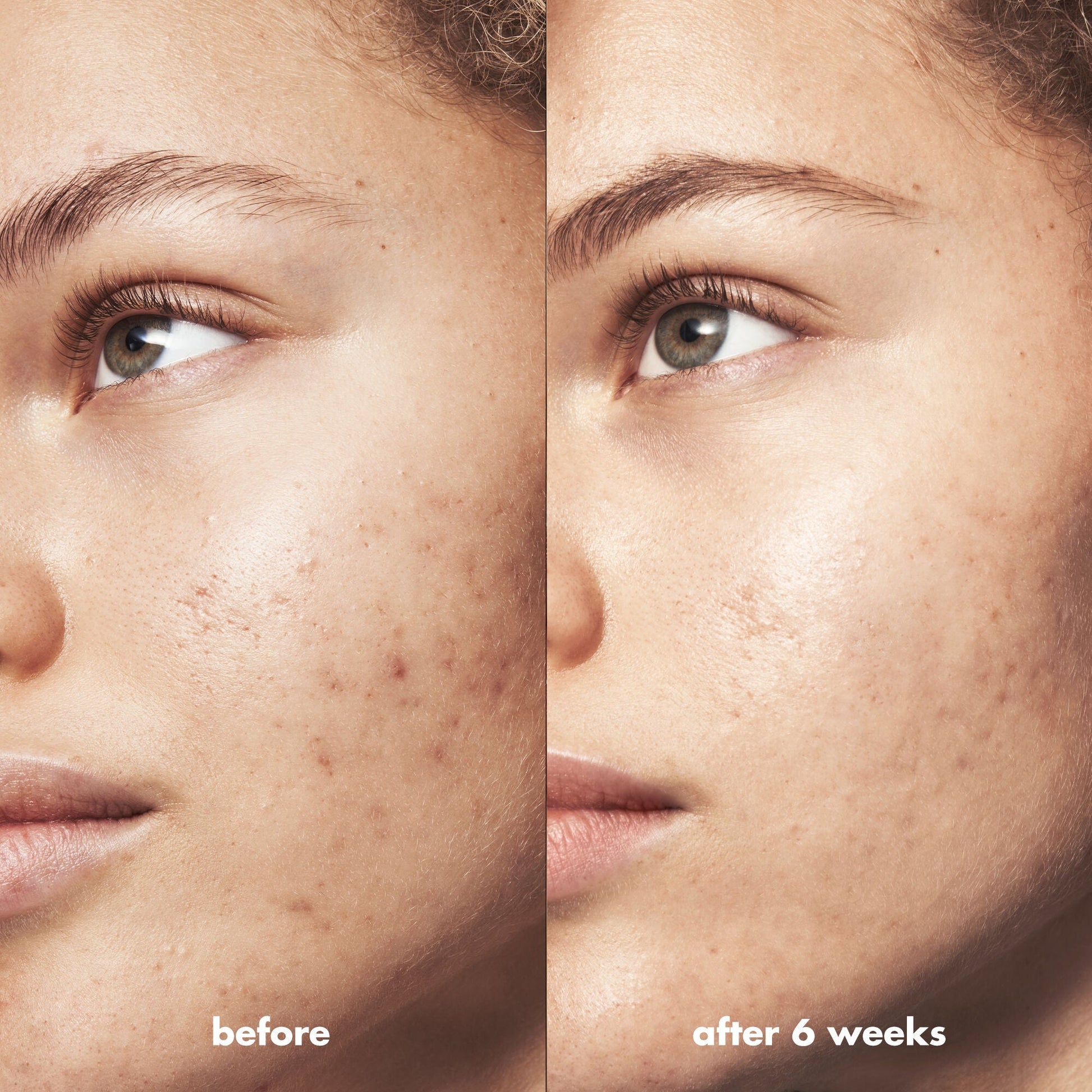 blemish-breakthrough-blemish-control-basics-kit-k2 Acne_PDP_Marley_Before_After_295728d2-6728-4f48-b8ef-c82bbca5b591.jpg